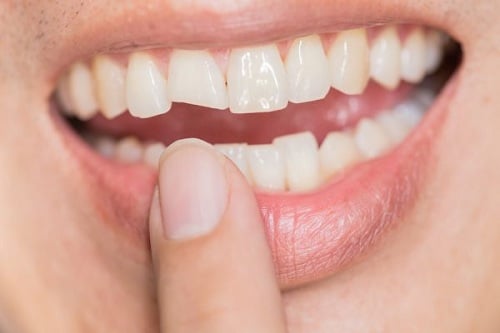 Bọc răng sứ uy tín tại Đà Nẵng