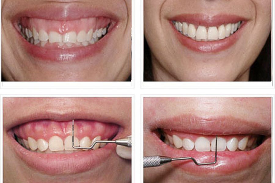 Nhấn lợi tạo đường cười là gì?