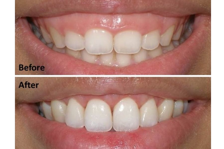 Trường hợp nào nên nhấn lợi tạo đường cười?