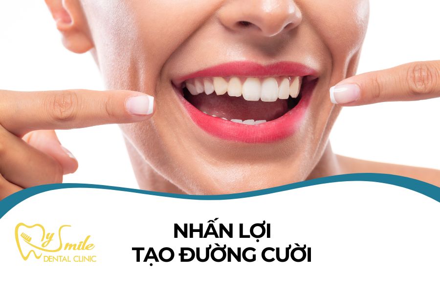 Nhấn lợi tạo đường cười (cắt lợi) uy tín Đà Nẵng
