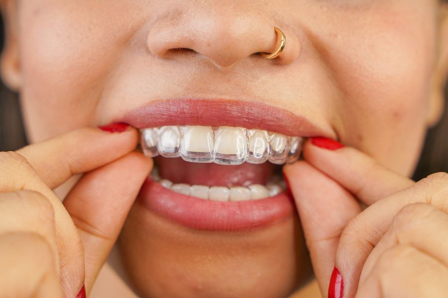 Ưu điểm của niềng răng Invisalign Đà Nẵng