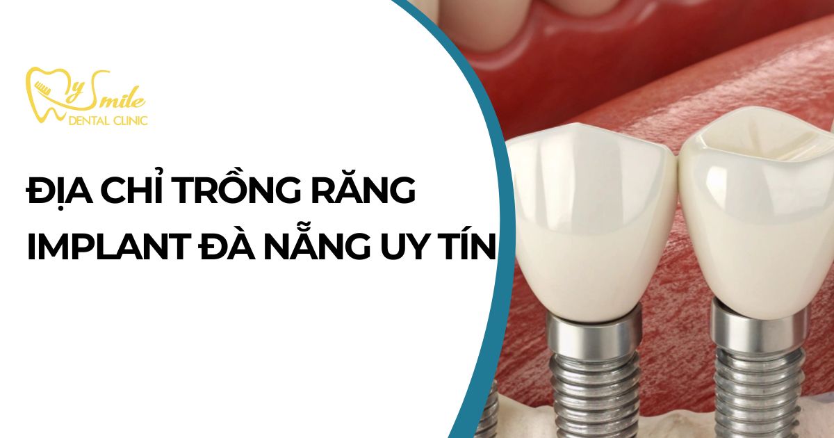Địa chỉ trồng răng Implant Đà Nẵng uy tín