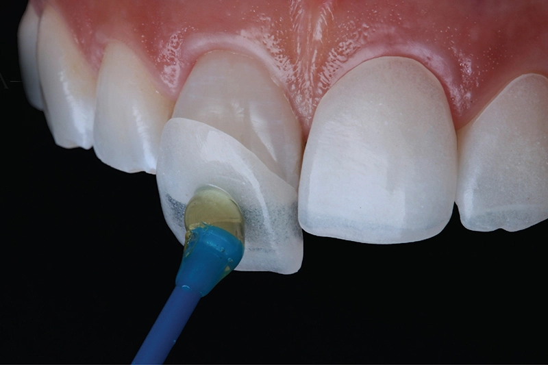 Bọc răng sứ tại Đà Nẵng có hiệu quả được bao lâu?