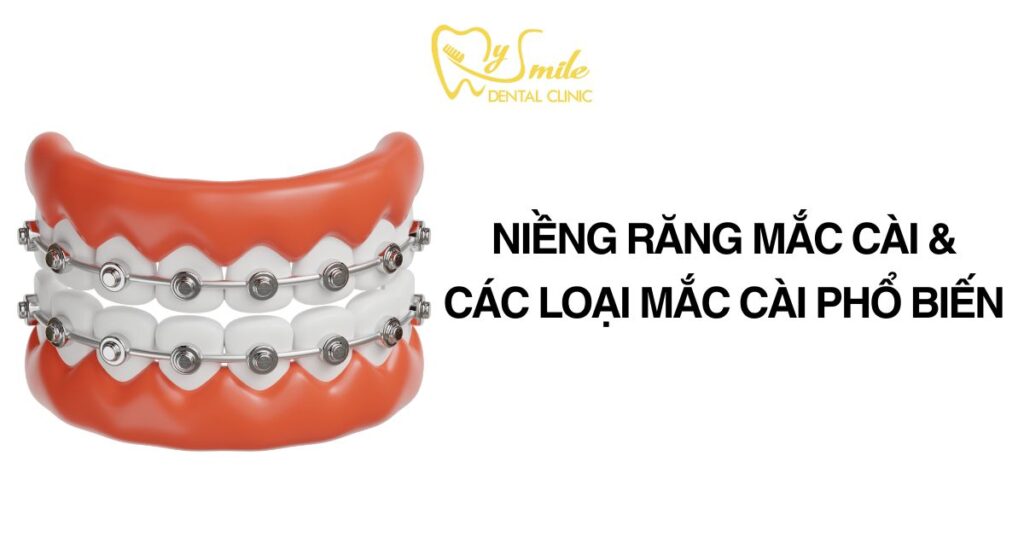 Niềng răng mắc cài