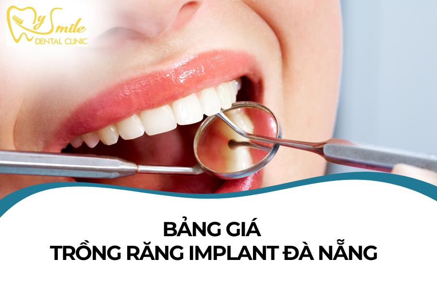 Bảng giá trồng răng implant Đà Nẵng chi tiết nhất