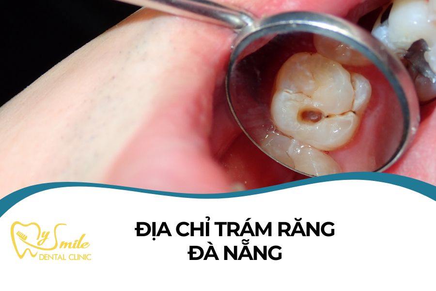4 địa chỉ trám răng tại Đà Nẵng nổi bật