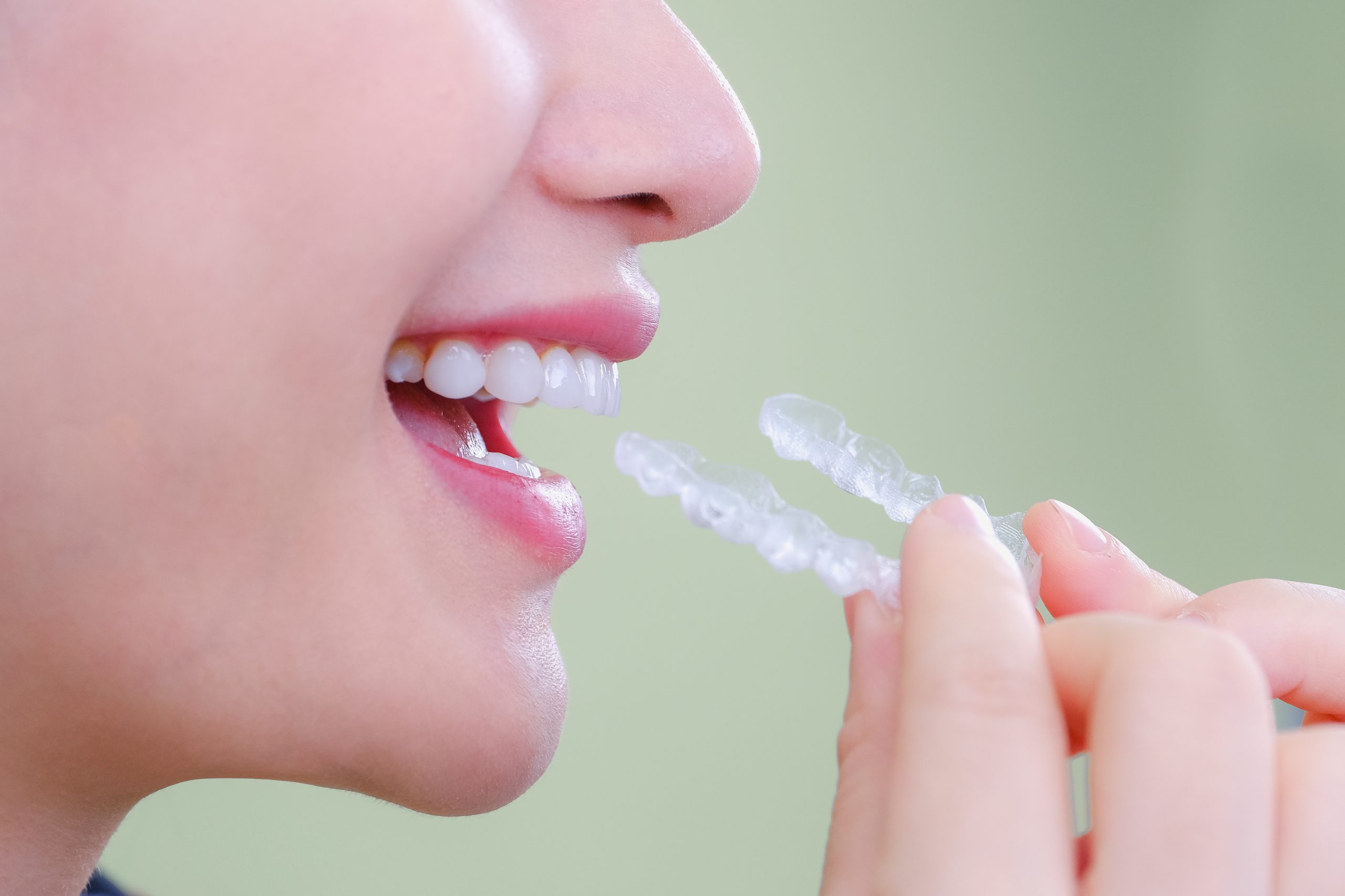 giá dịch vụ nha khoa Niềng răng trong suốt Invisalign
