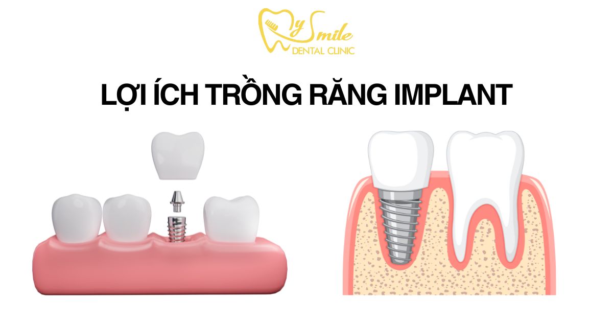 Lợi ích trồng răng Implant
