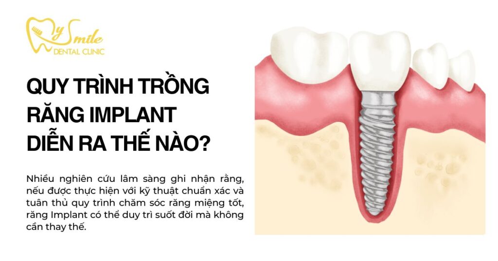 Quy trình trồng răng Implant