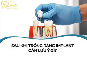 Sau khi trồng răng Implant cần lưu ý gì? Hướng dẫn chăm sóc