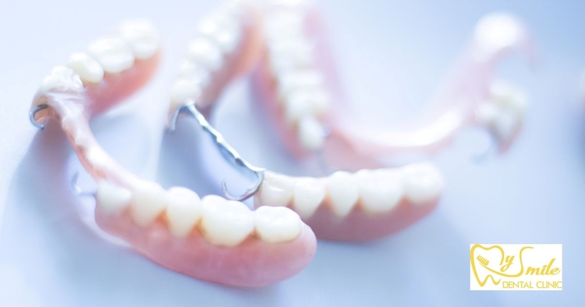 Chi phí trồng răng cửa giả tháo lắp dao động từ 300.000 - 400.000 đồng/răng