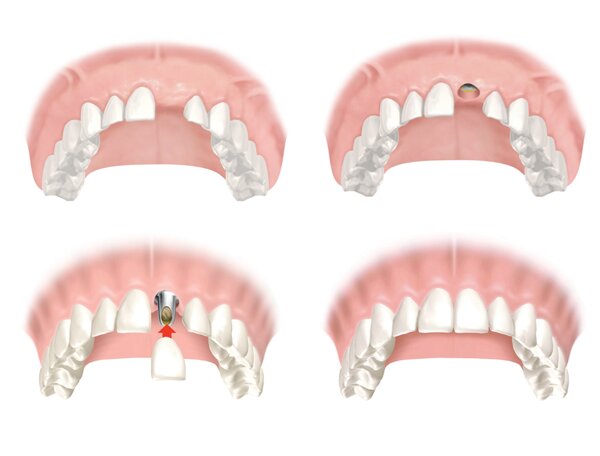 Trồng răng cửa bao nhiêu tiền với Implant?