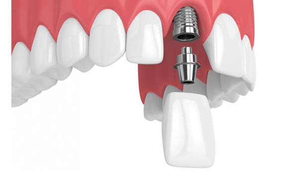 Trồng răng cửa có thể phát sinh thêm một số khoản chi phí tùy vào tình trạng răng và xương hàm