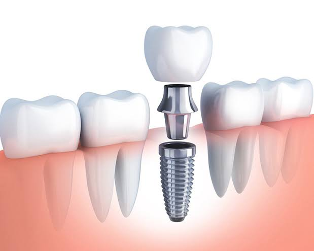 Trồng răng Implant được coi là giải pháp tối ưu nhất về cả chức năng và thẩm mỹ
