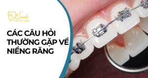 Câu hỏi thường gặp về niềng răng