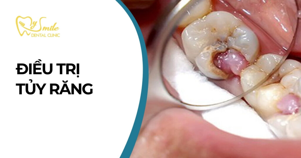 Điều trị tủy răng
