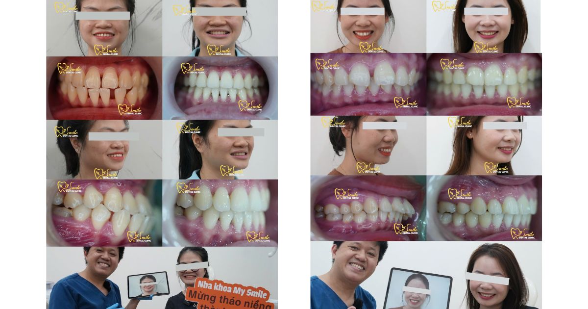 Niềng răng Đà Nẵng uy tín