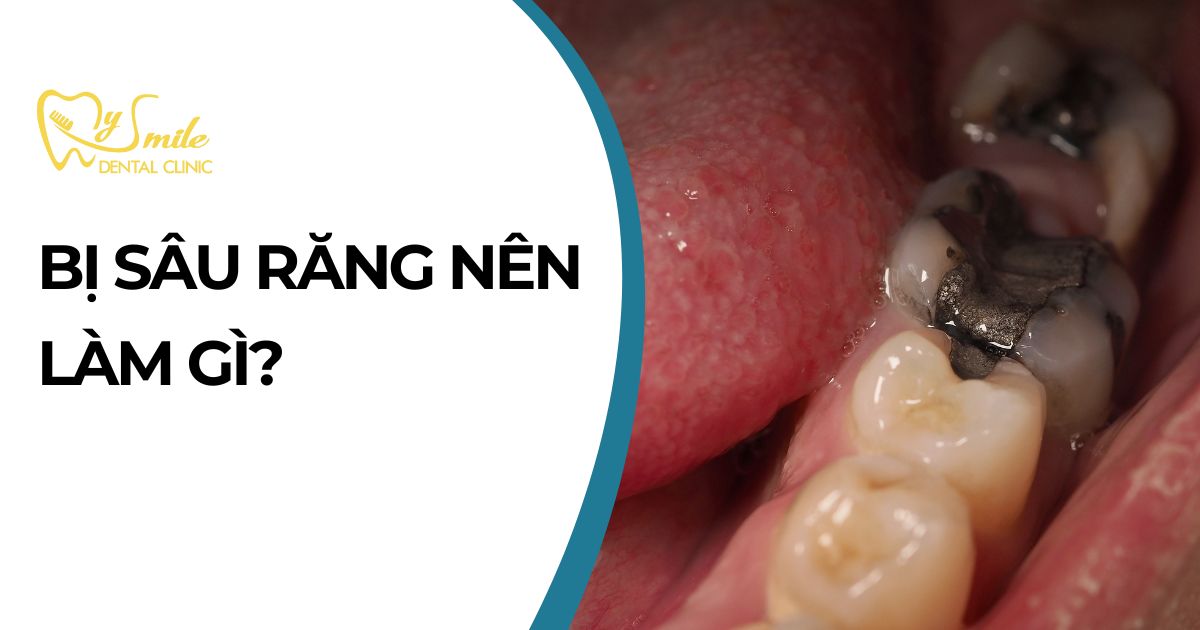 Bị sâu răng nên làm gì? Cách chữa sâu răng hiệu quả - Mysmileclinic
