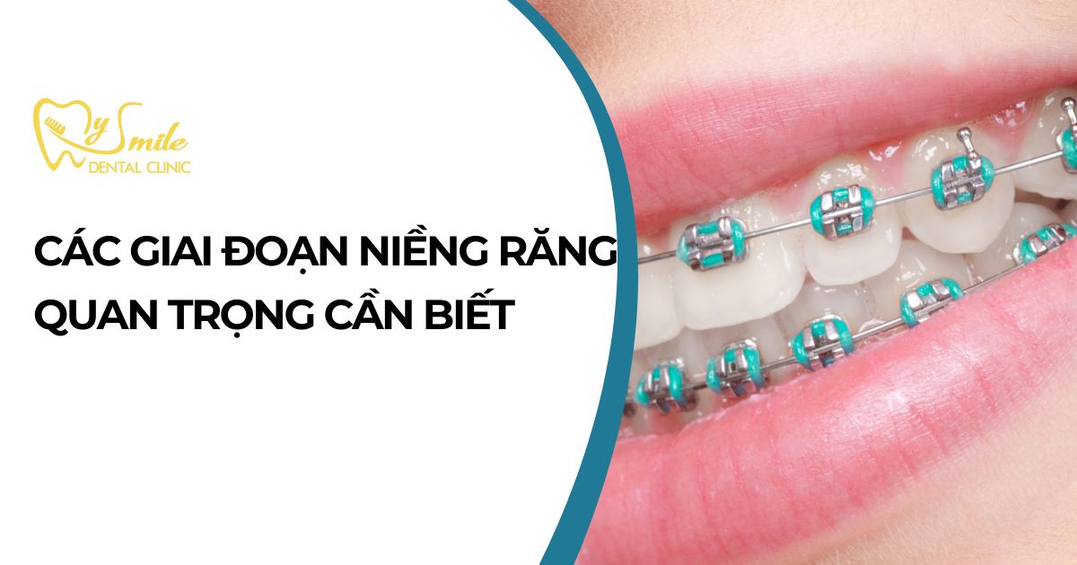 Các giai đoạn niềng răng quan trọng bạn cần nắm