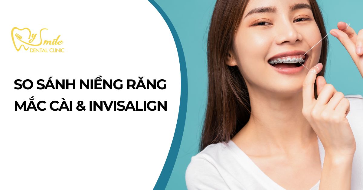 So sánh niềng răng mắc cài và Invisalign