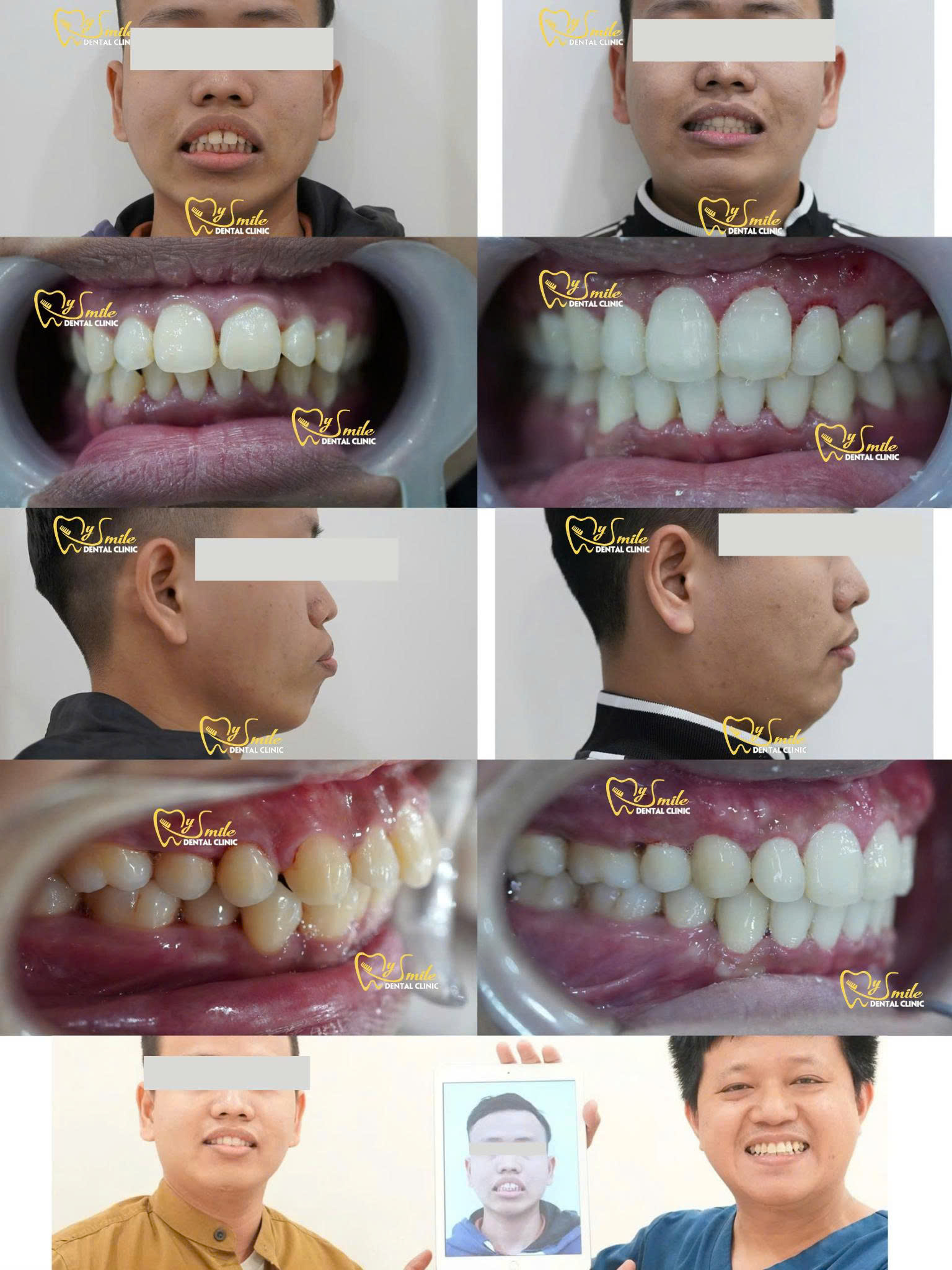 Xem thêm các trường hợp niềng răng thành công tại Nha khoa My Smile