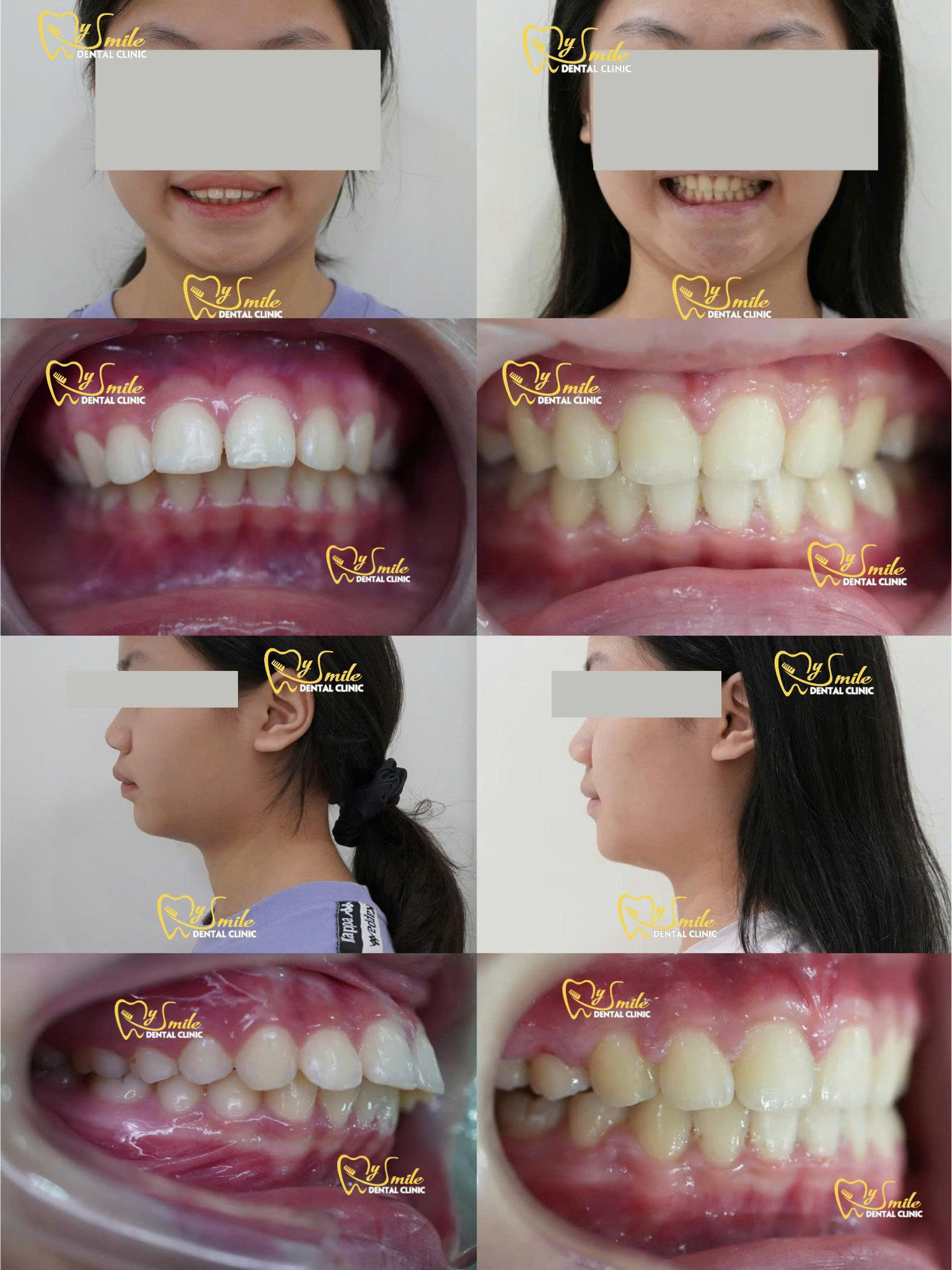 Niềng răng đẹp uy tín - chất lượng cao - ít đau tại Nha khoa My Smile Đà Nẵng