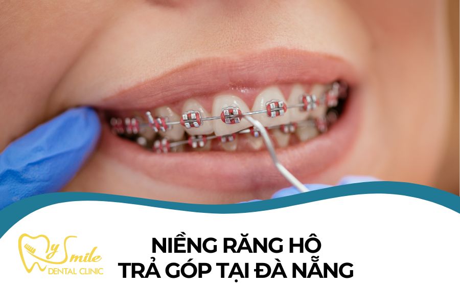 niềng răng hô trả góp tại Đà Nẵng