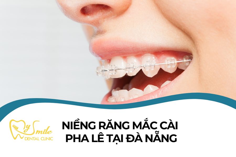 Niềng răng mắc cài pha lê tại Đà Nẵng