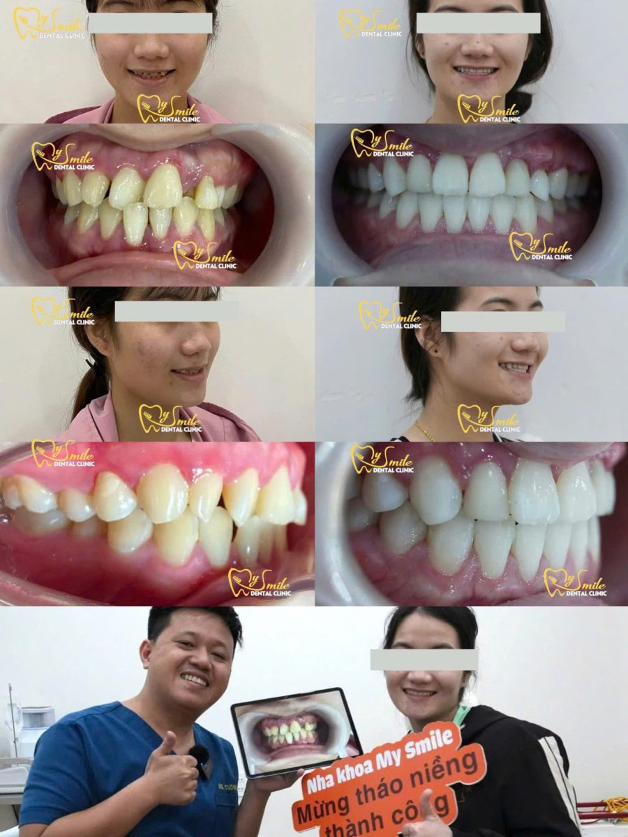 ảnh niềng răng khấp khểnh 5