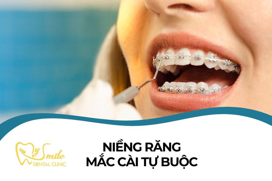 niềng răng mắc cài tự buộc
