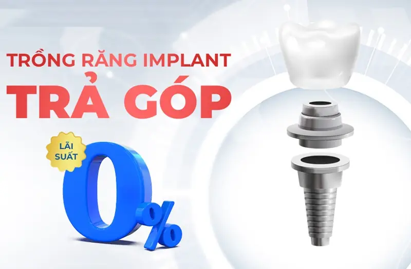 Trước khi đăng ký trồng răng Implant trả góp Đà Nẵng, nên hỏi rõ chi phí và phương thức thanh toán