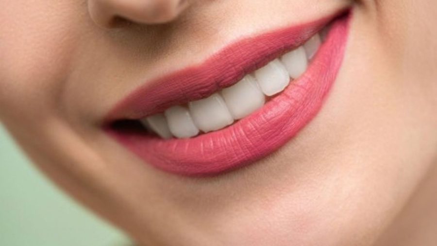 Niềng răng giúp cải thiện thẩm mỹ nụ cười và tái tạo khớp cắn chuẩn xác
