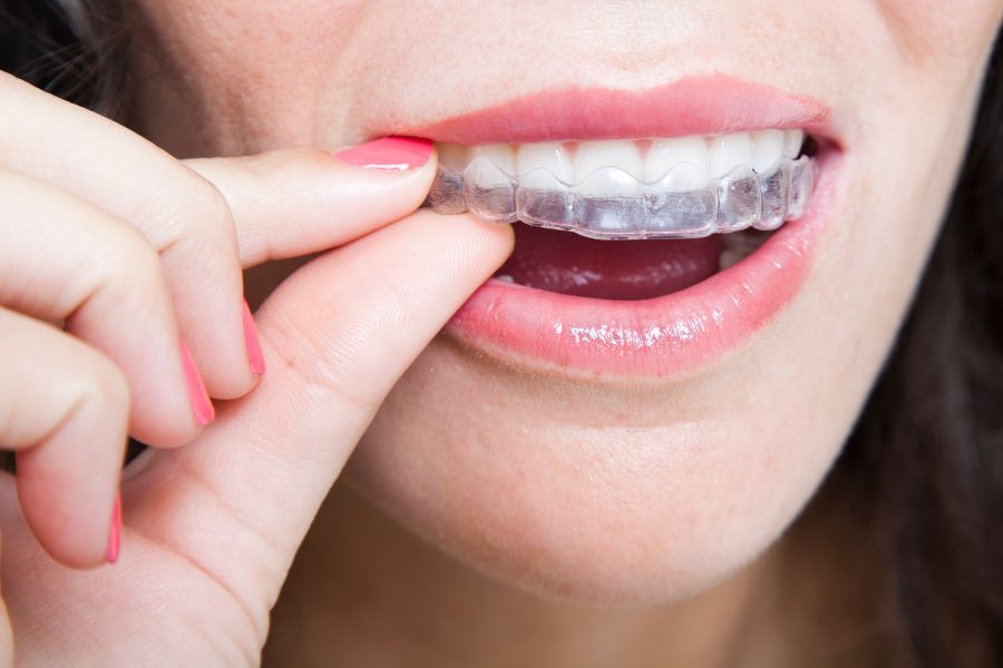 Phương pháp niềng răng trong suốt tiên tiến, thẩm mỹ cao và linh hoạt khi sử dụng