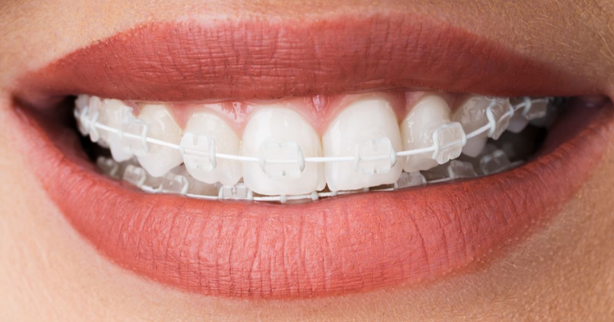 Niềng răng mắc cài sứ giúp tăng tính thẩm mỹ và sự tự tin trong suốt quá trình điều trị