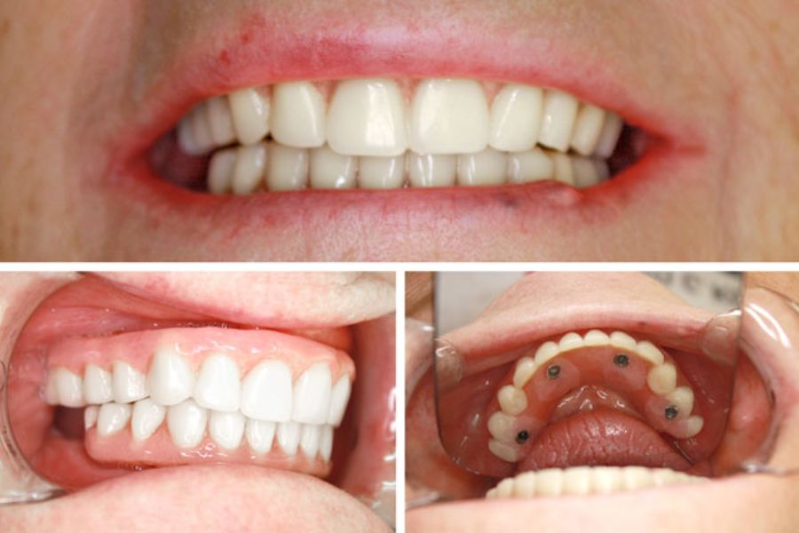 Hình ảnh thực tế khoang miệng khách hàng sau khi phục hình răng toàn hàm bằng công nghệ All-on-4