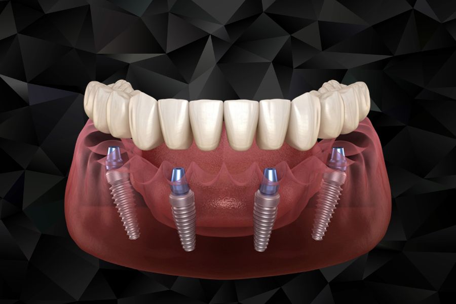 Mô hình đồ họa minh họa kỹ thuật trồng răng Implant All-on-4 sử dụng 4 trụ nâng đỡ toàn bộ hàm răng cố định