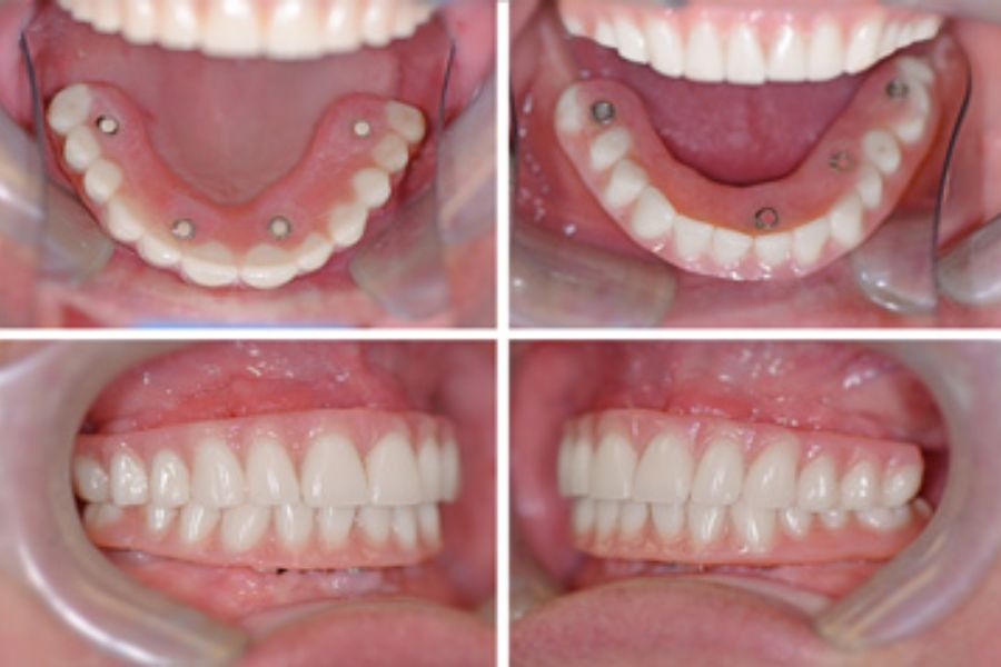 Hình ảnh thực tế vị trí đặt trụ Implant và hàm răng cố định hoàn chỉnh giúp cải thiện thẩm mỹ khuôn mặt