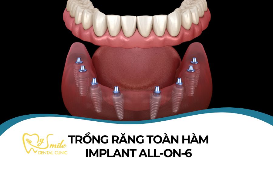 Trồng răng toàn hàm All-on-6 là gì? Cách trồng, Chi phí
