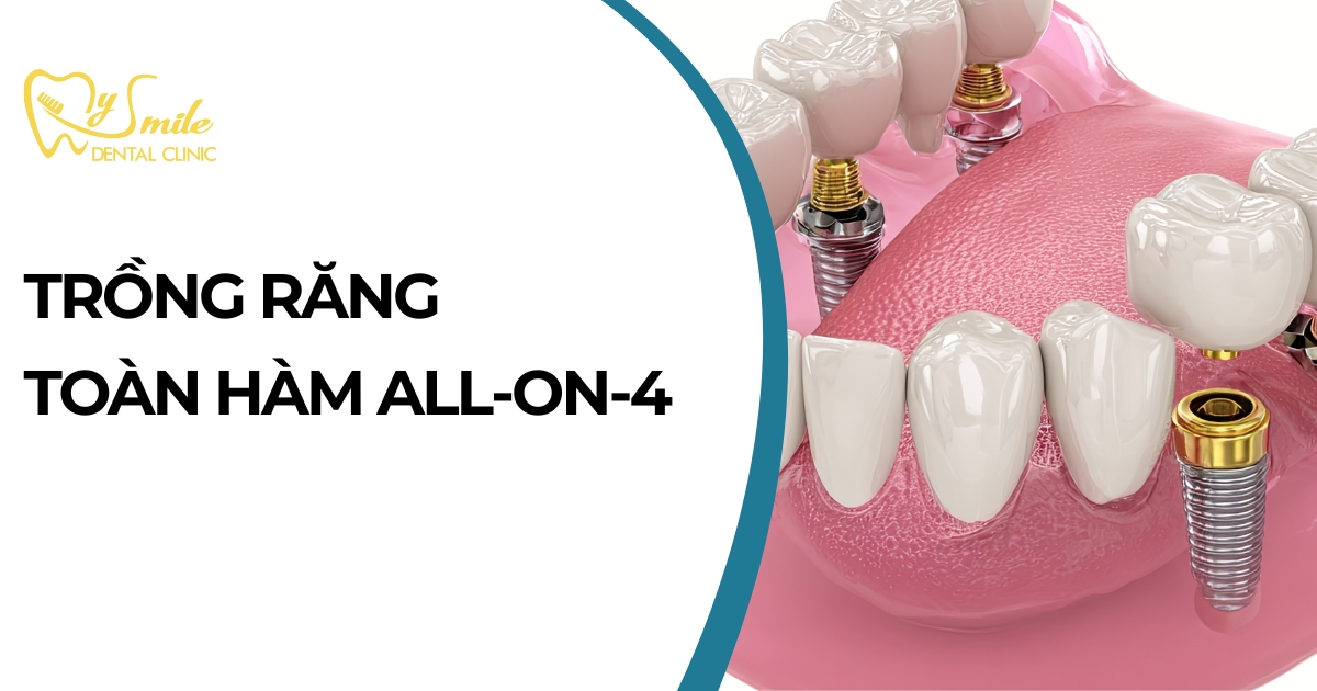 Trồng răng toàn hàm All-on-4