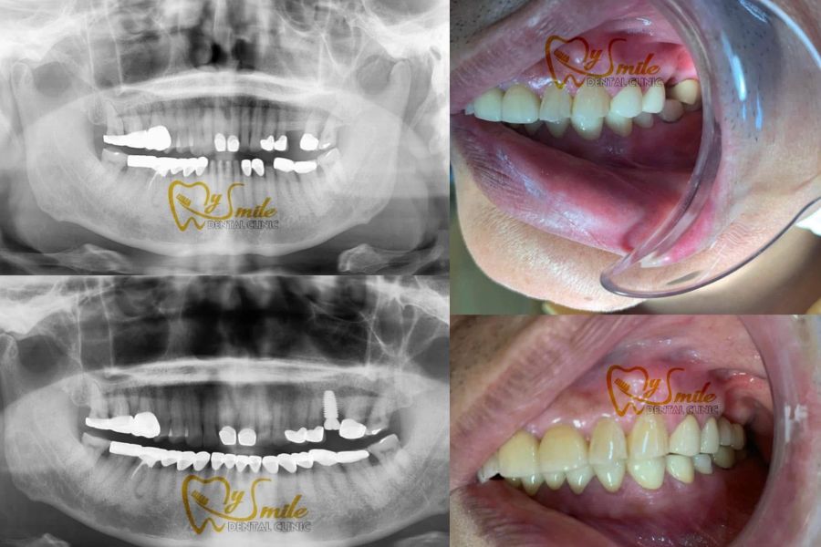 Trồng răng Implant Hàn Quốc tại Nha khoa My Smile