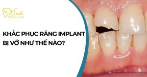 Cách khắc phục răng Implant bị vỡ