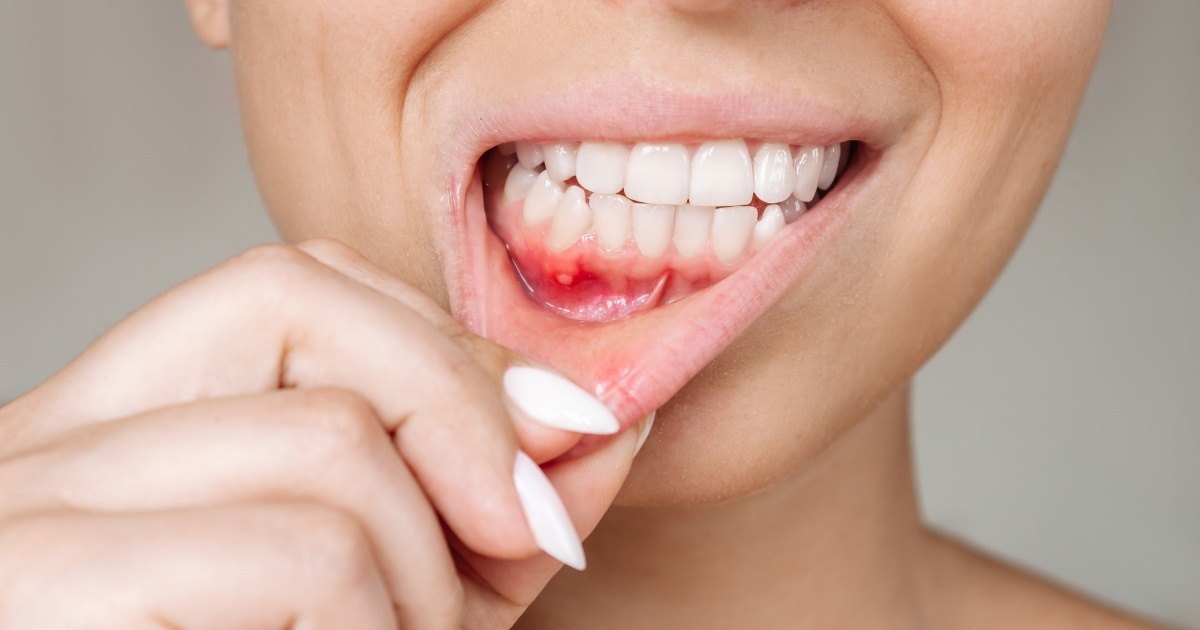 Dấu hiệu đào thải trụ Implant