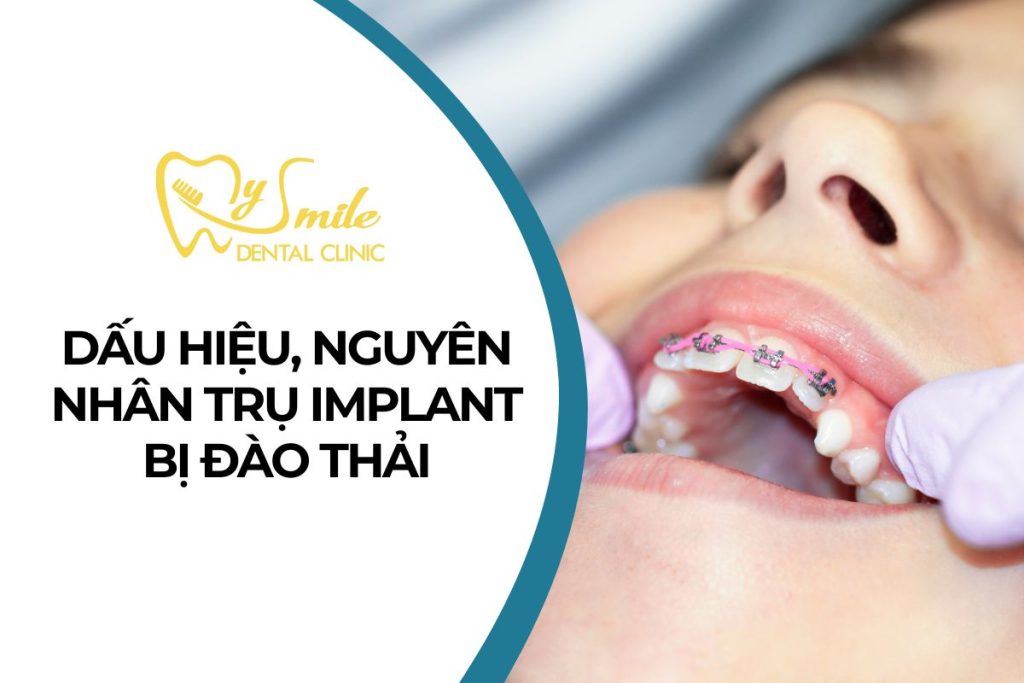 Các dấu hiệu trụ Implant đào thải: Nguyên nhân, Giải pháp