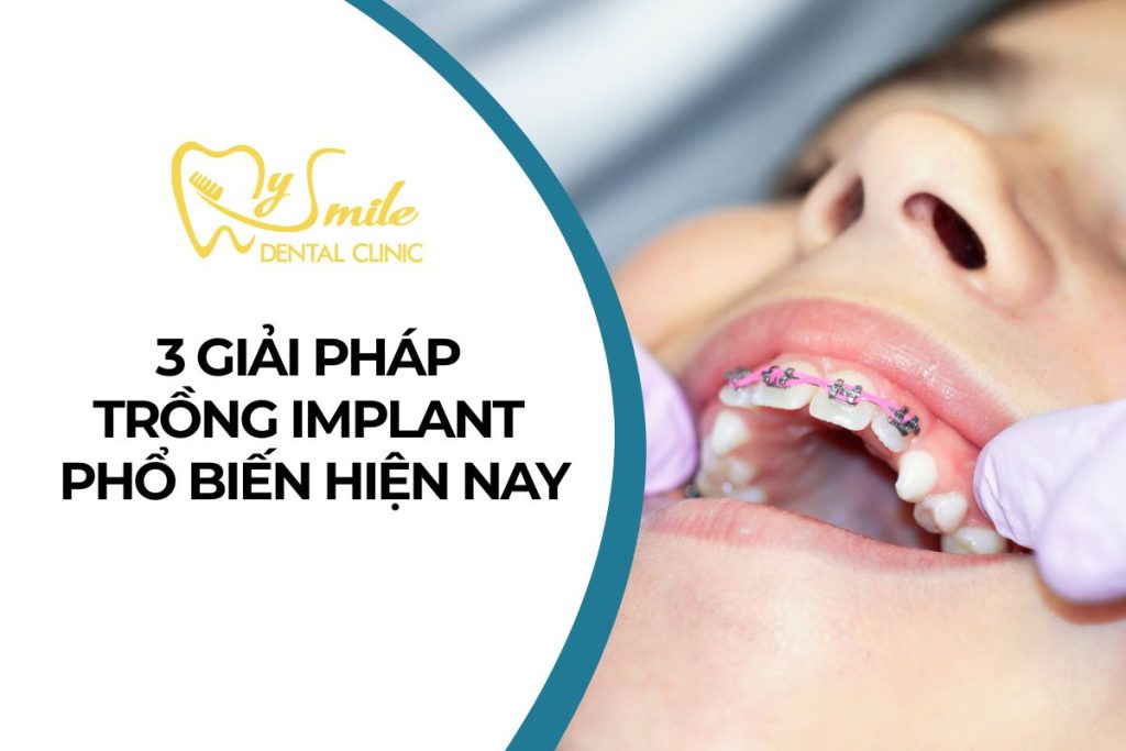 3 giải pháp trồng răng Implant phổ biến hiện nay