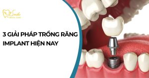 3 giải pháp trồng răng Implant hiện nay
