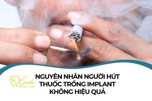 Nguyên nhân người hút thuốc trồng Implant không hiệu quả