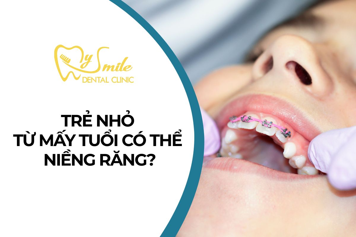 Trẻ nhỏ từ mấy tuổi có thể niềng răng? Phương pháp nào tốt?