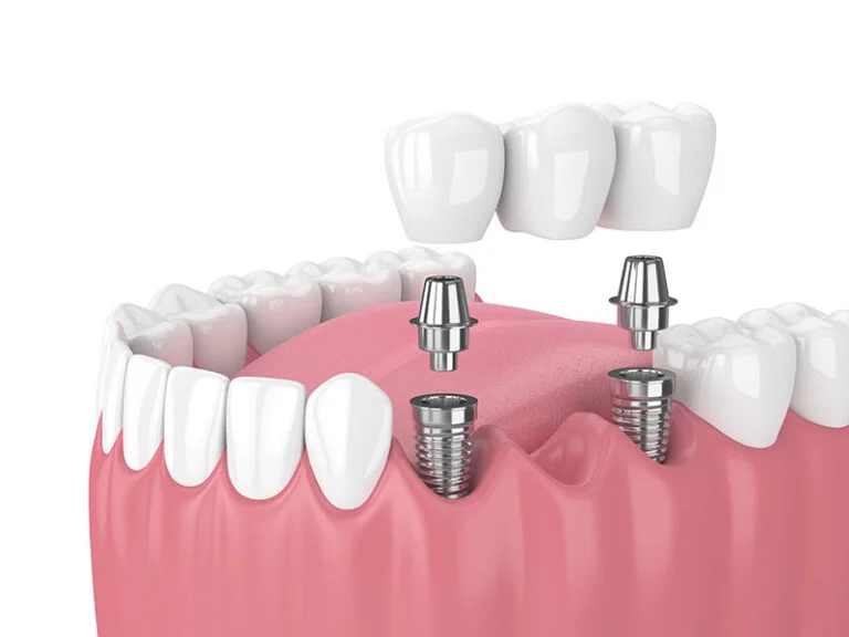 Cấy ghép Implant cho nhiều răng mất liên tiếp