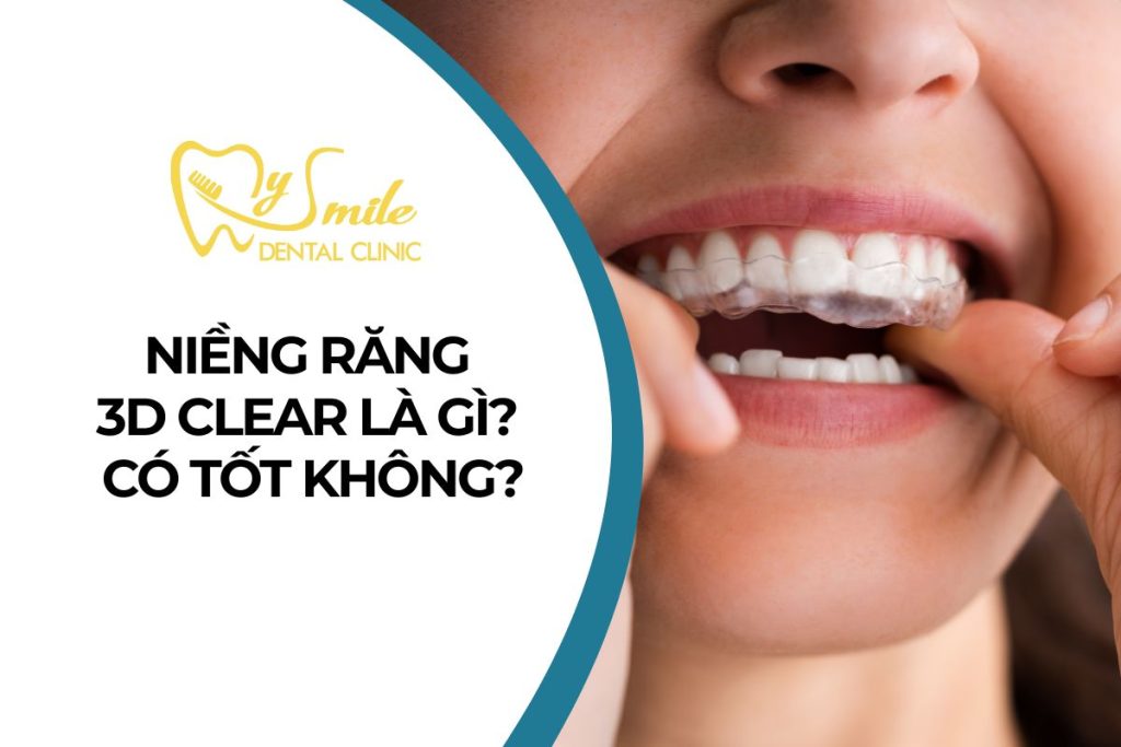 Niềng răng 3D Clear là gì? Có hiệu quả không? Giá thành