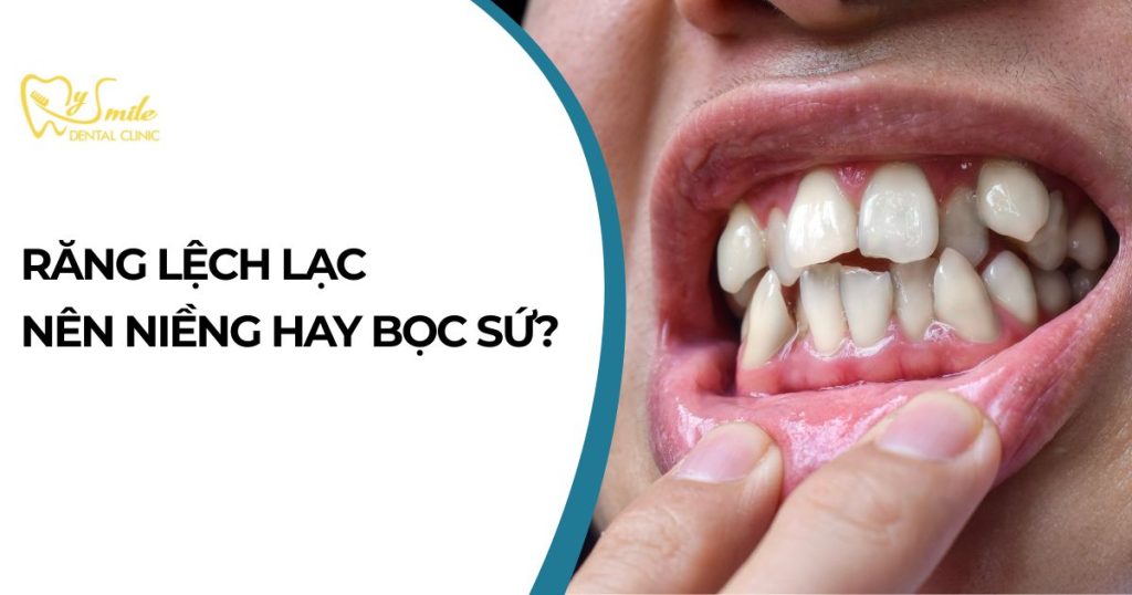 Răng lệch lạc nên niềng hay bọc sứ